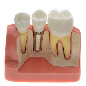 Analysis Model for Dental Implant M2017