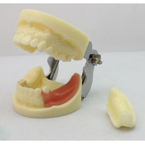 ENOVO Brand Dental Implant Study Model with Removable Teeth